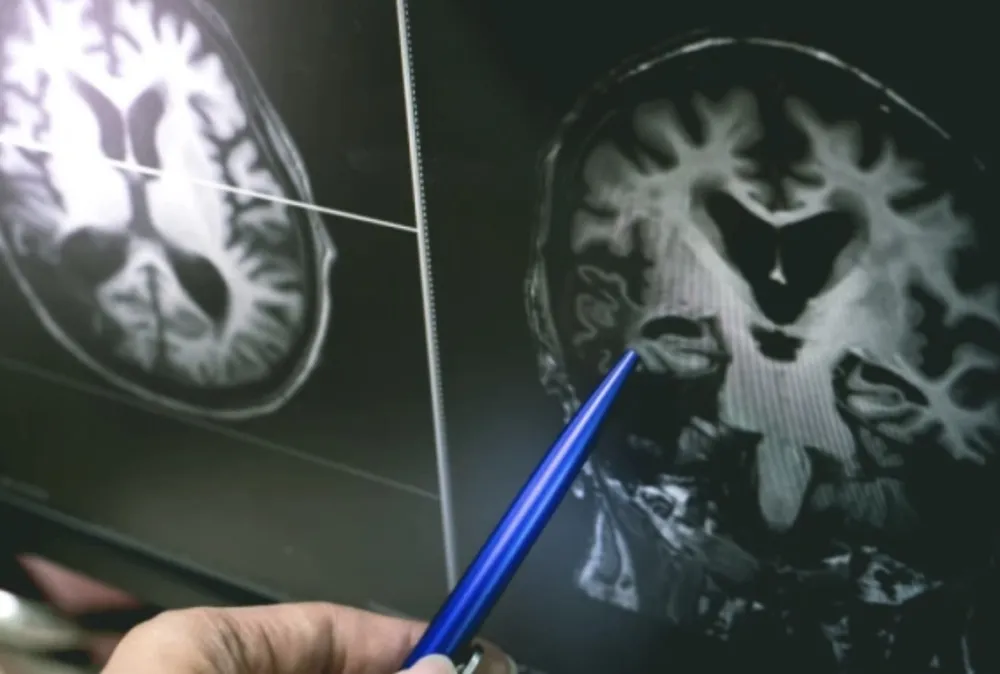 Matične ćelije bi mogle da oporave mozak posle &scaron;loga