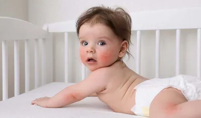 Kako prepoznati alergijsku reakciju na hranu kod beba i kada je potrebna medicinska pomoć