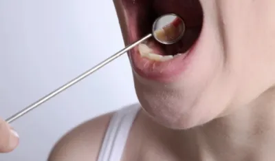 Ovih pet&nbsp;lo&scaron;ih navika drastično povećavaju rizik za nastanak kancera usne duplje