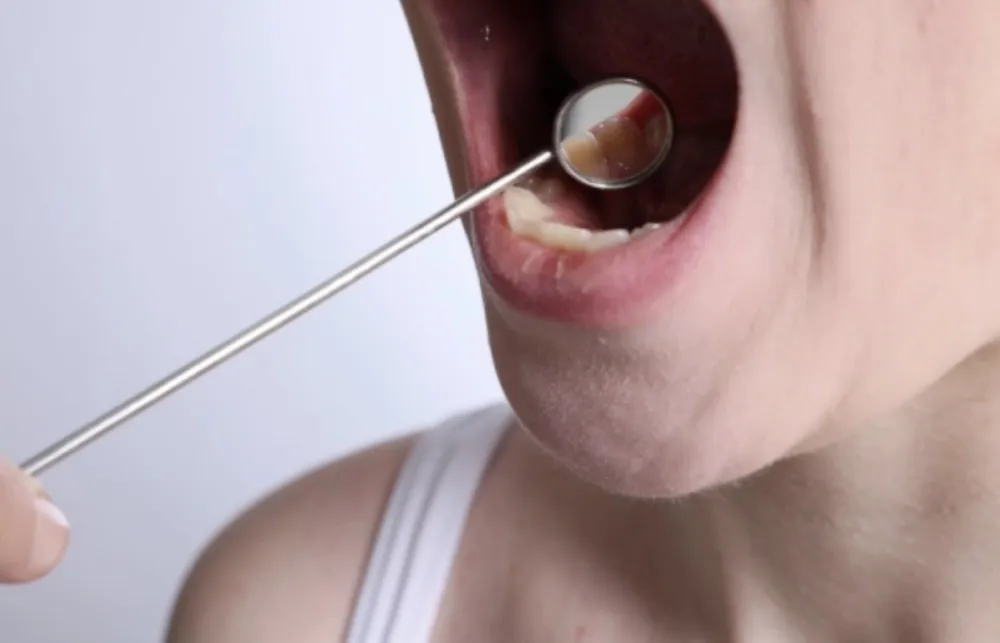 Ovih pet&nbsp;lo&scaron;ih navika drastično povećavaju rizik za nastanak kancera usne duplje