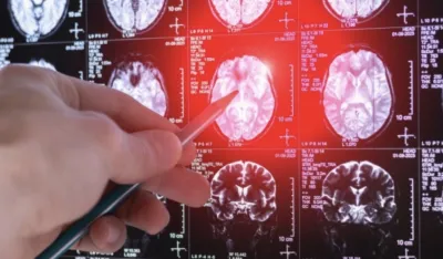 Nije svaka glavobolja rak mozga: Ljekar upozorava kada je vrijeme da potražite pomoć