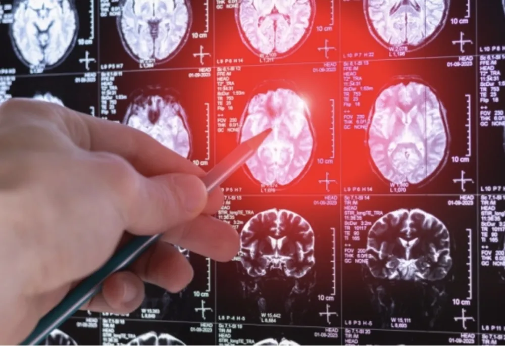 Nije svaka glavobolja rak mozga: Ljekar upozorava kada je vrijeme da potražite pomoć