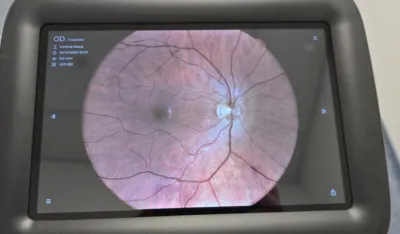 Pilot-projekat teleoftalmologije &ndash; brža i dostupnija za&scaron;tita vida