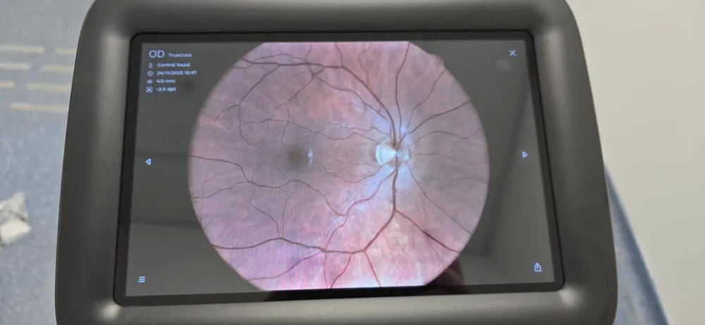 Pilot-projekat teleoftalmologije &ndash; brža i dostupnija za&scaron;tita vida