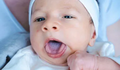 Bijeli jezik kod beba: &Scaron;ta znači i kada se treba zabrinuti?