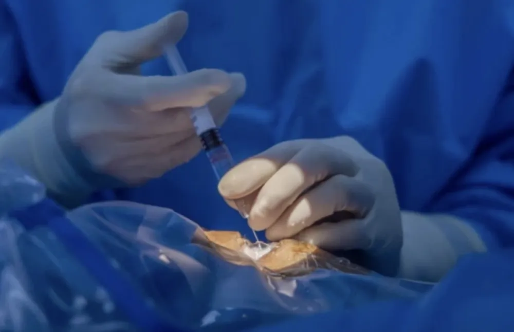 Revolucionarna injekcija gela u oko: Nada za hiljade ljudi&nbsp;