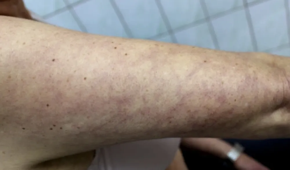 Ove promjene na koži mogu ukazivati na opasne kardiovaskularne probleme