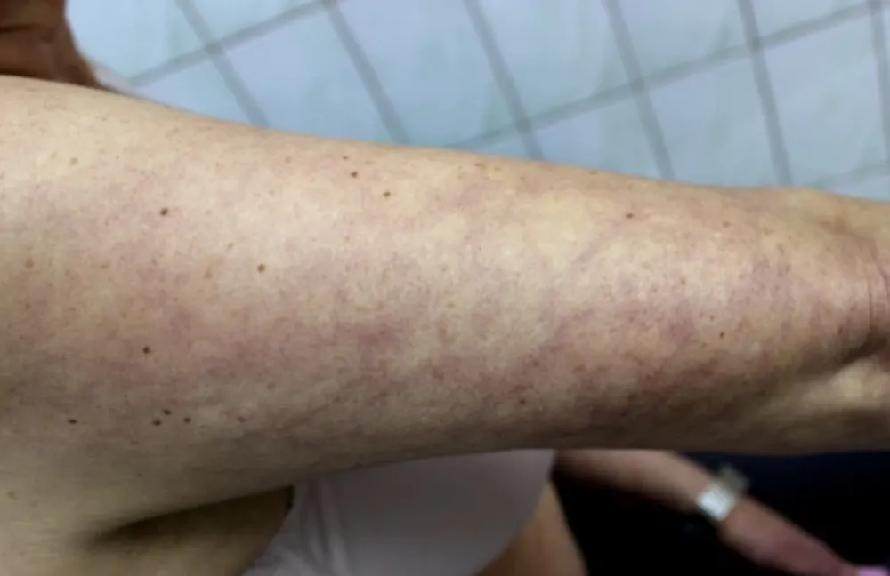 Ove promjene na koži mogu ukazivati na opasne kardiovaskularne probleme