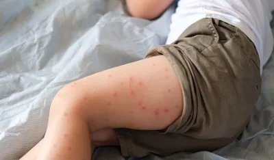 Epidemija malih boginja &scaron;iri se Londonom: Evo &scaron;ta je važno da zna svaki roditelj