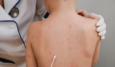 Stav Ombudsmana: Roditelji bez informacija o vakcinaciji, medicinari istupaju kampanjski