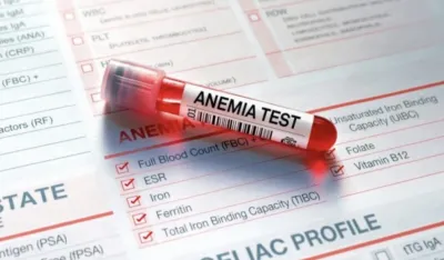 Koji su znaci i simptomi anemije uzrokovane nedostatkom gvožđa