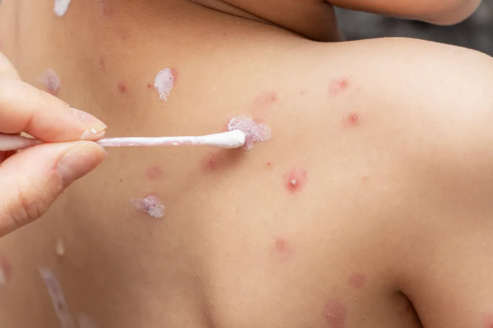 Ove godine registrovan 441 slučaj ovčijih boginja