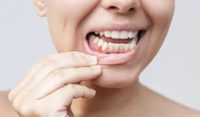 Često vam krvare desni? Uzrok može biti nedostatak važnog vitamina
