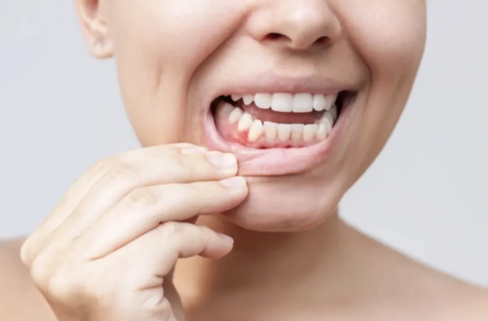 Često vam krvare desni? Uzrok može biti nedostatak važnog vitamina