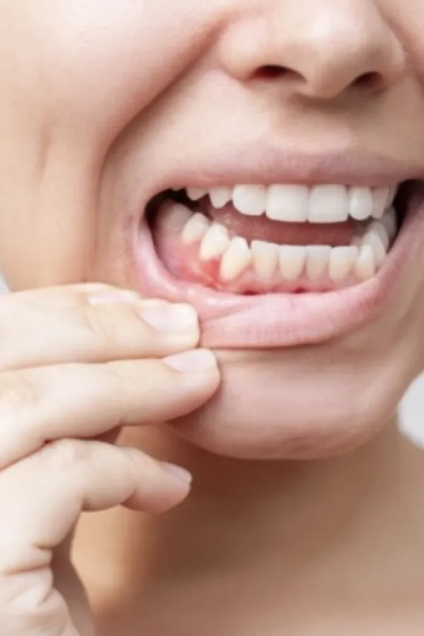 Često vam krvare desni? Uzrok može biti nedostatak važnog vitamina