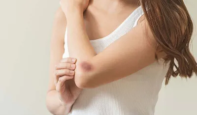 Primijetili ste da vam lako ostaju modrice na tijelu? Evo &scaron;ta mogu biti uzroci