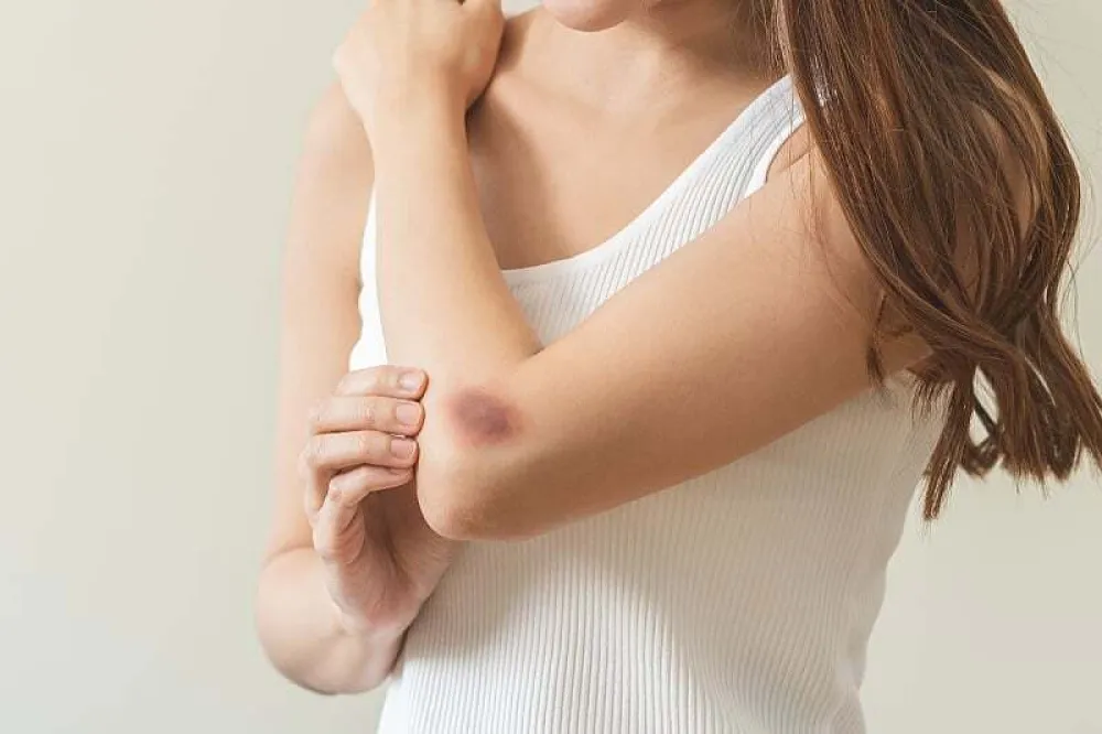 Primijetili ste da vam lako ostaju modrice na tijelu? Evo &scaron;ta mogu biti uzroci