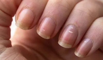 &Scaron;ta znače promjene na noktima: Evo kada trebate posjetiti ljekara