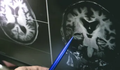 Nova terapija može odložiti Alchajmerovu bolest i to za sedam godina
