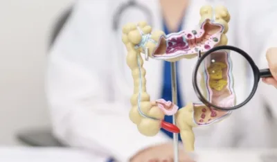 Sve veći porast raka debelog crijeva kod mladih: Niko nije premlad za ovu dijagnozu