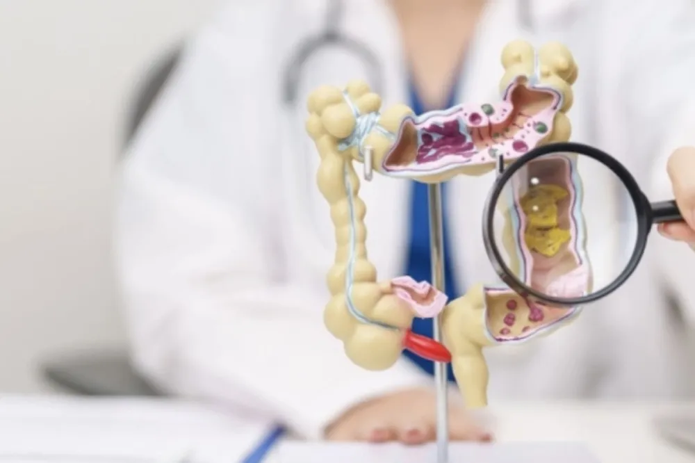 Sve veći porast raka debelog crijeva kod mladih: Niko nije premlad za ovu dijagnozu