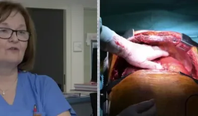 Prva transplatacija pluća u Srbiji