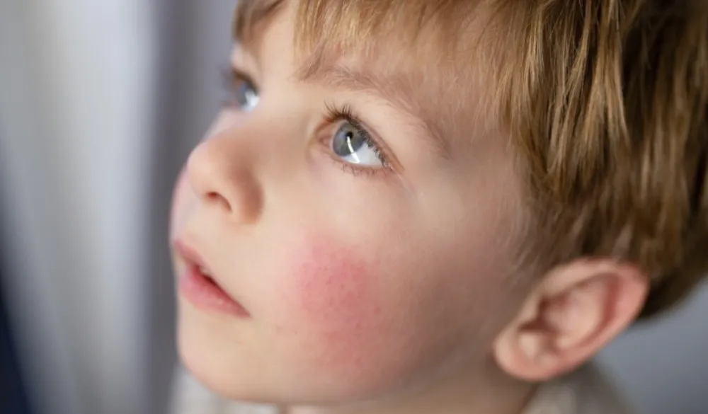 Dermatolog savjetuje kako se boriti sa atopijskim dermatitisom