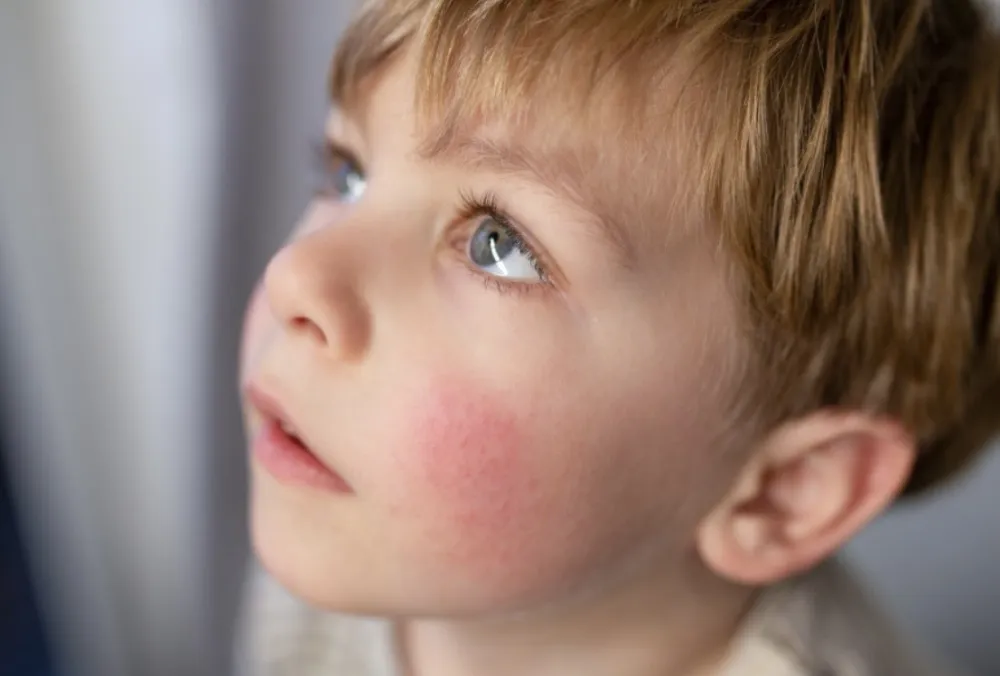 Dermatolog savjetuje kako se boriti sa atopijskim dermatitisom