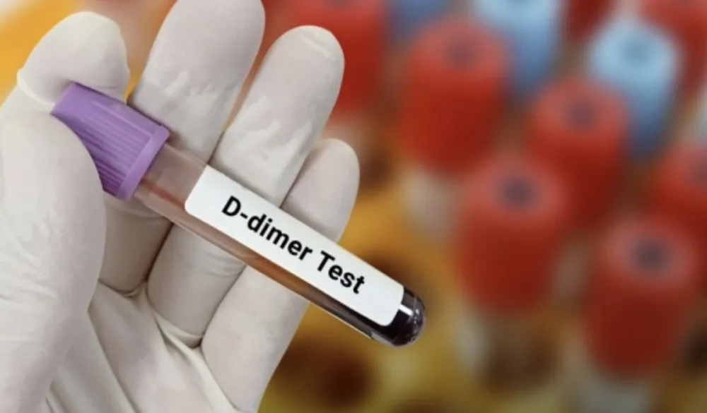 D-dimer test: &Scaron;ta znači povi&scaron;en nalaz i kada je vrijeme za brigu?