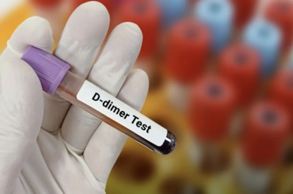 D-dimer test: &Scaron;ta znači povi&scaron;en nalaz i kada je vrijeme za brigu?