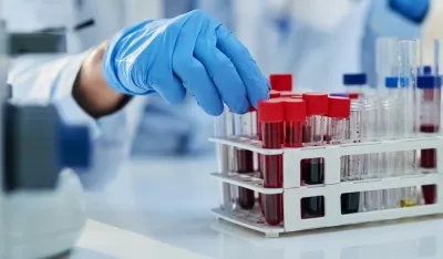 Krvni test otkriva znakove Alchajmerove bolesti "decenijama prije simptoma"