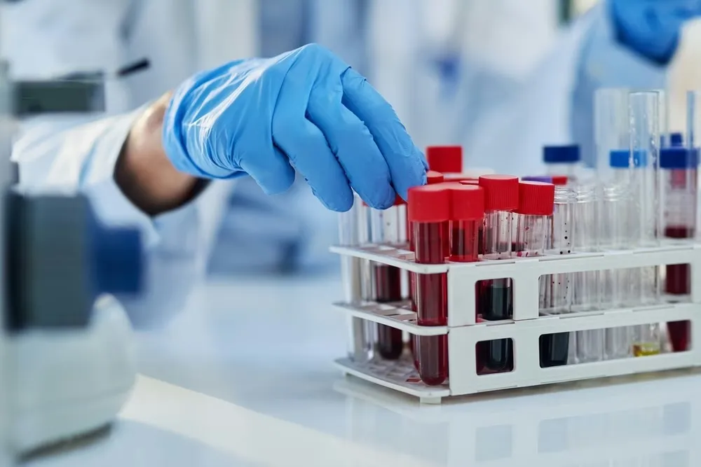 Krvni test otkriva znakove Alchajmerove bolesti "decenijama prije simptoma"