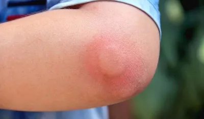 &Scaron;ta učiniti ako va&scaron;e dijete ubode pčela ili osa