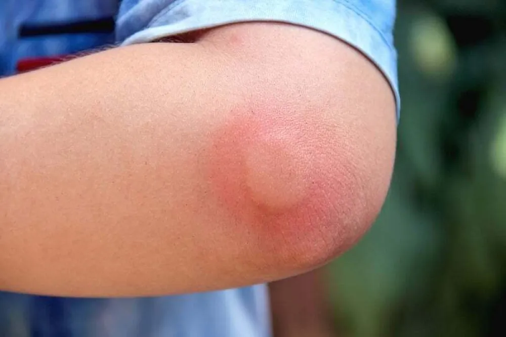 &Scaron;ta učiniti ako va&scaron;e dijete ubode pčela ili osa