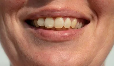 &Scaron;ta uzrokuje bijele mrlje na zubima i kako ih se rije&scaron;iti