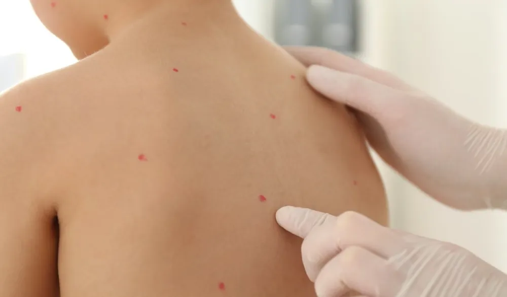 Ovčje boginje kod djece - kakvi su simptomi i na koji način se liječe