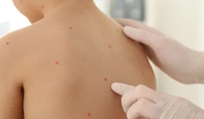 Ovčje boginje kod djece - kakvi su simptomi i na koji način se liječe