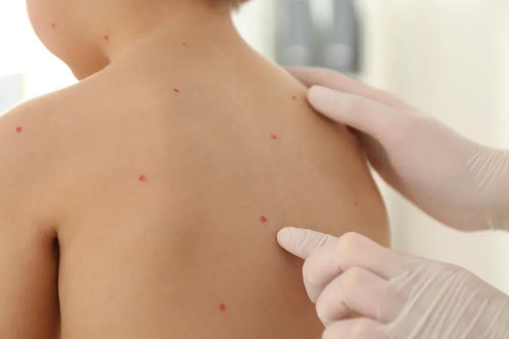 Ovčje boginje kod djece - kakvi su simptomi i na koji način se liječe