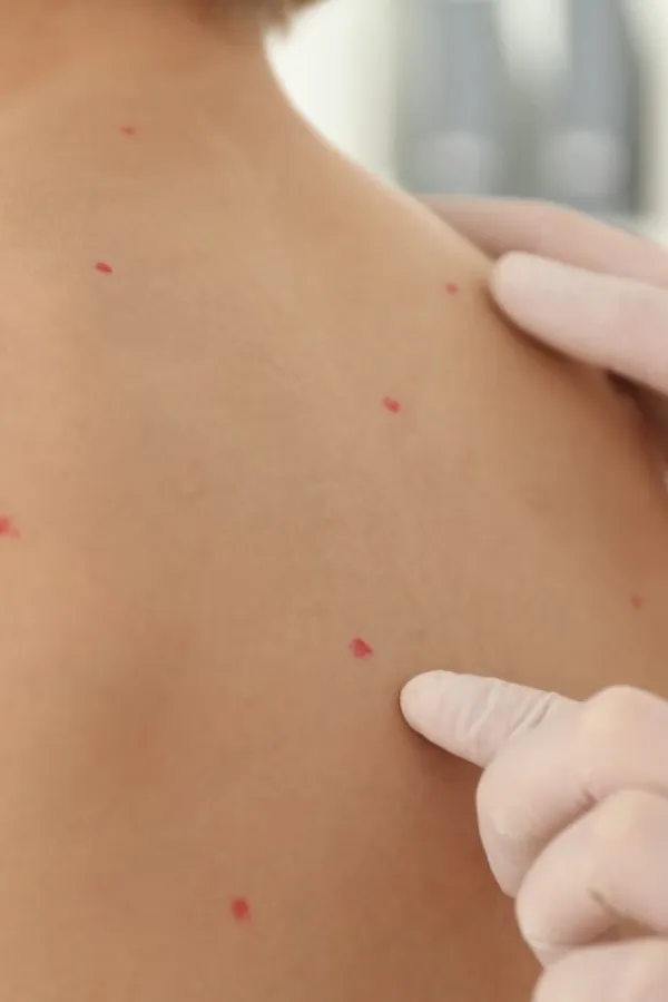 Ovčje boginje kod djece - kakvi su simptomi i na koji način se liječe