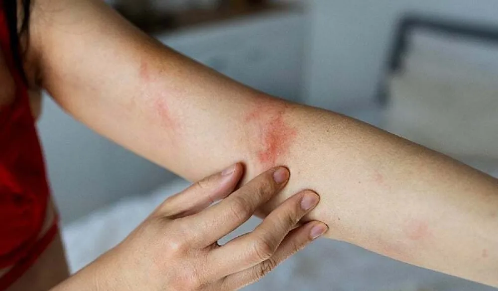 Promjene na koži mogu signalizirati dijabetes