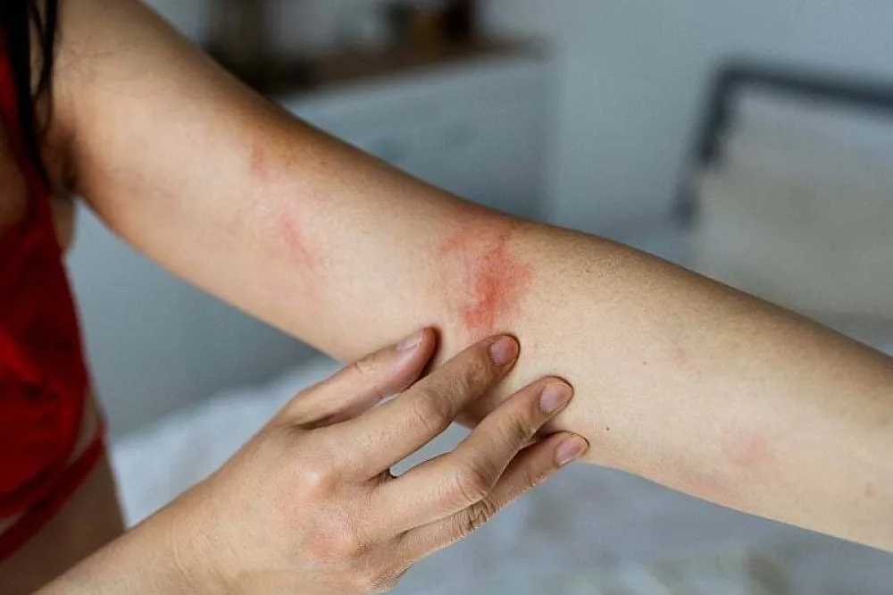 Promjene na koži mogu signalizirati dijabetes