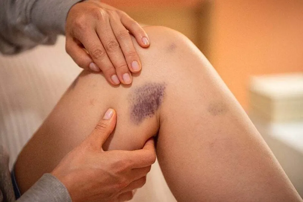 Često vam se pojavljuju modrice na tijelu? Ovo su mogući razlozi zbog kojih nastaju